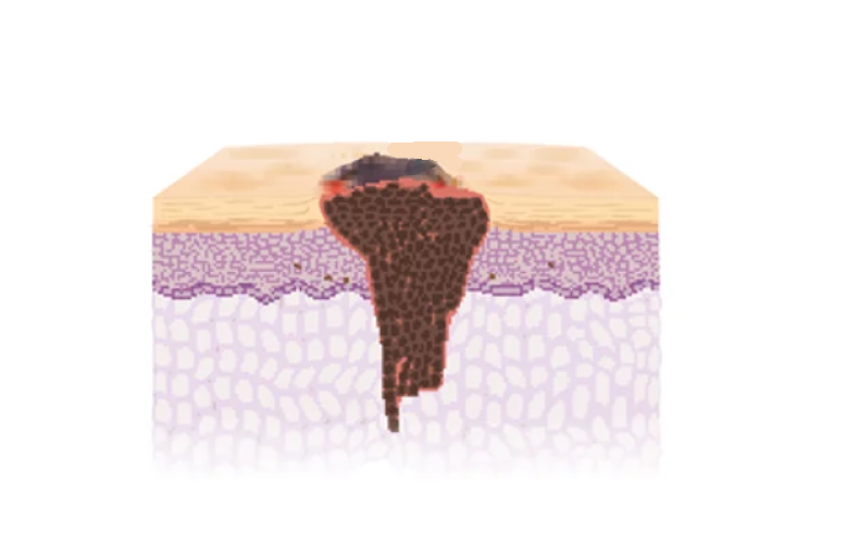 Aufbau eines Malignes Melanoms