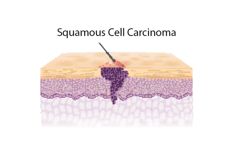 Bild des Aufbaues des Plattenepithelkarzinoms