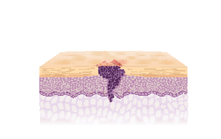 Bild des Aufbaus eines Plattenepithelkarzinoms